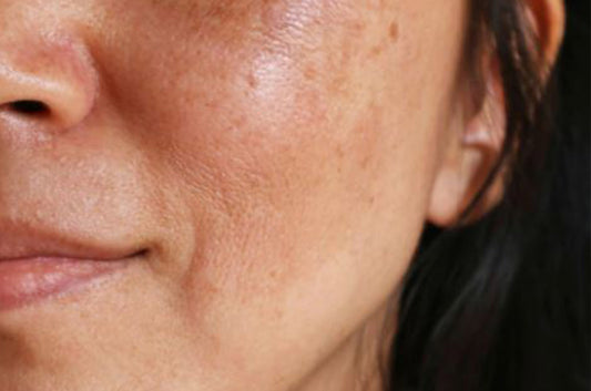 Comment estomper les tâches brunes ou tâches pigmentaires : Derm Acte